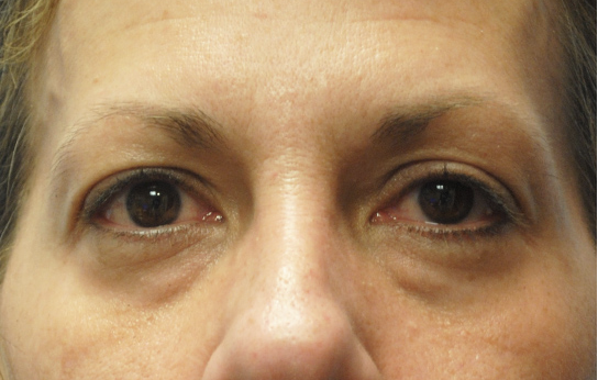 Eyelid Surgery Before