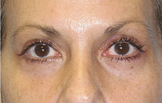 Eyelid Surgery After