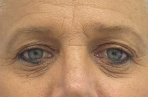 Eyelid Surgery Before