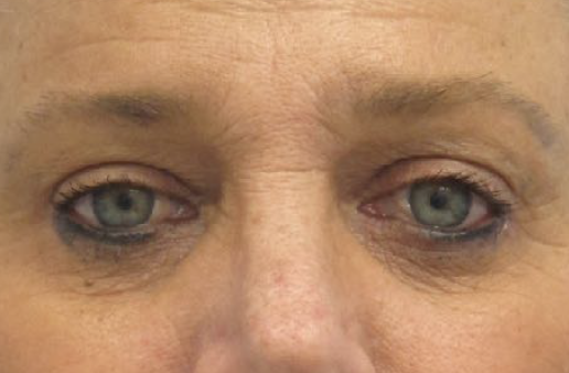 Eyelid Surgery After