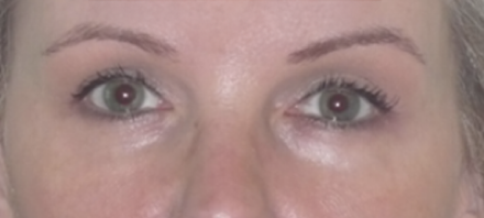 Eyelid Surgery After