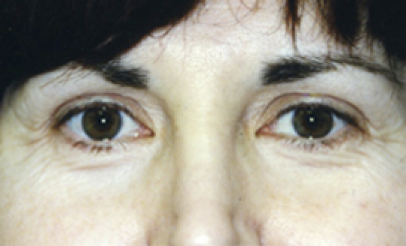 Eyelid Surgery Before