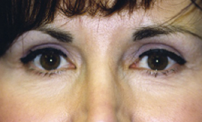 Eyelid Surgery After