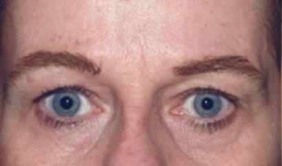 Eyelid Surgery Before