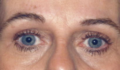 Eyelid Surgery After