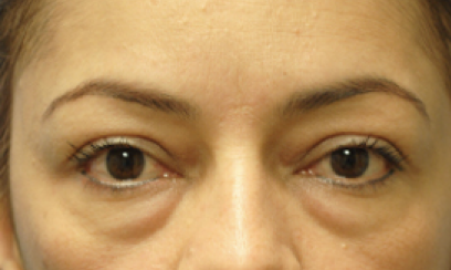 Eyelid Surgery Before