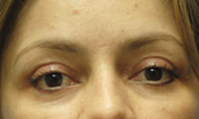 Eyelid Surgery After