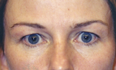 Eyelid Surgery Before