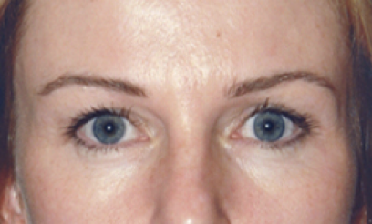 Eyelid Surgery After