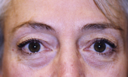 Eyelid Surgery Before