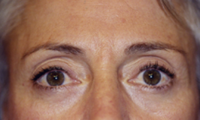 Eyelid Surgery After