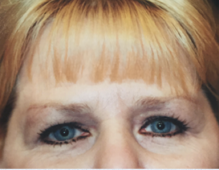 Brow Lift Before