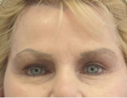 Brow Lift After