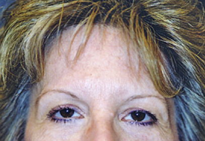 Brow Lift Before