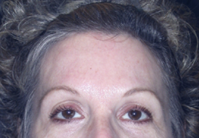 Brow Lift After