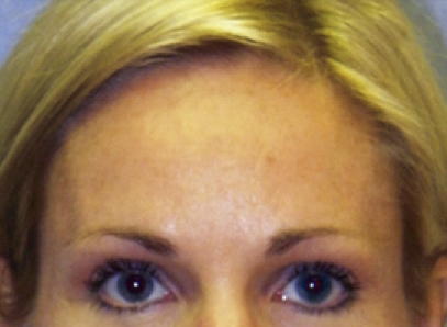 Brow Lift After