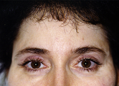 Brow Lift After