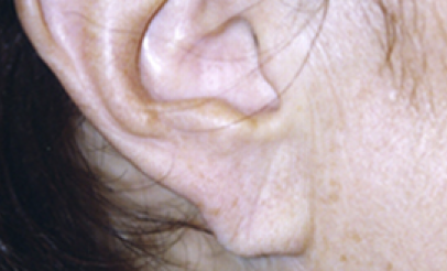 Earlobe Repair After