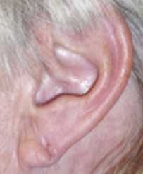 Earlobe Repair Before