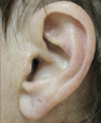 Earlobe Repair After