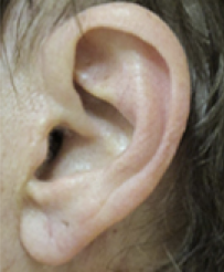 Earlobe Repair Before