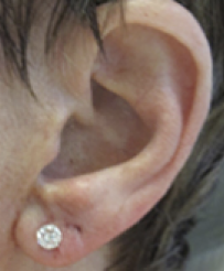 Earlobe Repair After