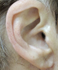 Earlobe Repair After