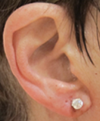 Earlobe Repair After