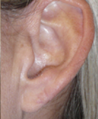 Earlobe Repair After