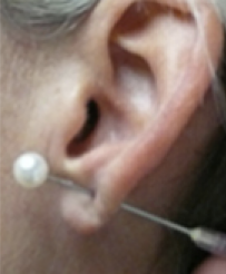 Earlobe Repair Before