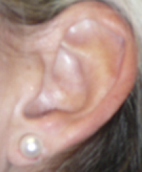 Earlobe Repair After