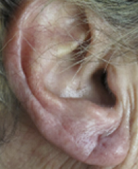 Earlobe Repair After