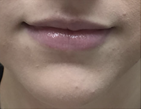 Lip Enhancement Before