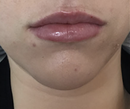 Lip Enhancement After