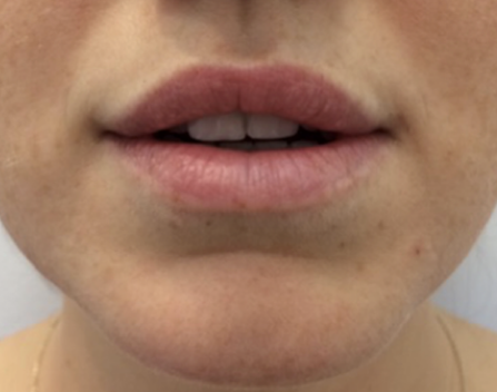 Lip Enhancement Before