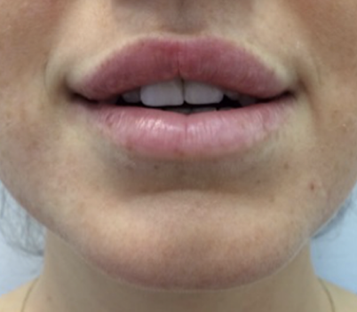 Lip Enhancement After