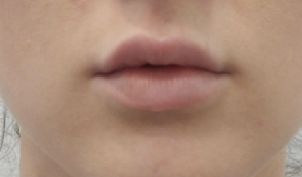 Lip Enhancement Before