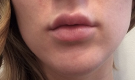 Lip Enhancement After