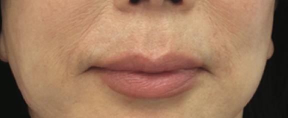 Lip Lift Before