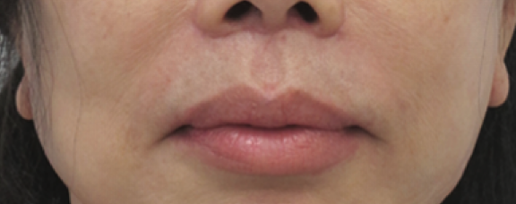 Lip Lift After