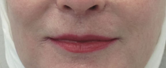 Lip Lift After