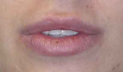 Lip Reduction Before