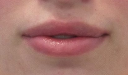 Lip Reduction After