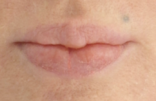 Lip Reduction Before