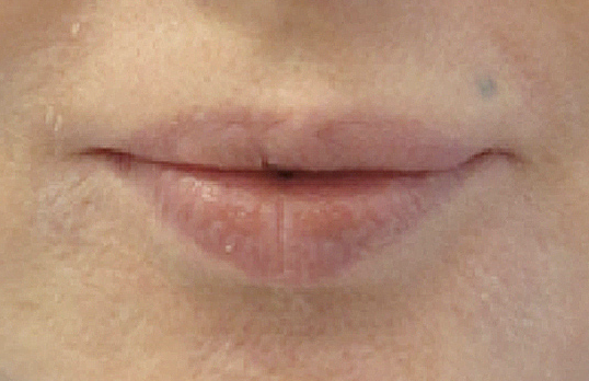 Lip Reduction After