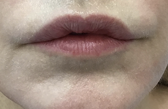 Lip Reduction Before