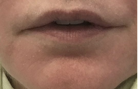 Lip Reduction After