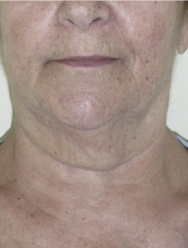 Microneedling with PRP Before