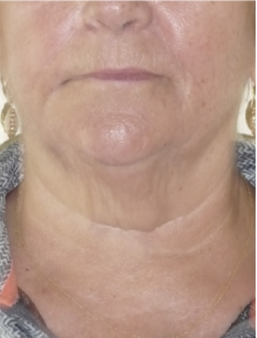 Microneedling with PRP After