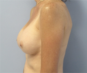 Breast Implants After